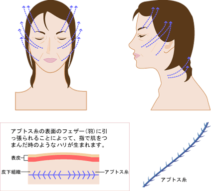 フェザーリフト(切らないフェイスリフト)
