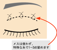 スタンダード埋没法とは