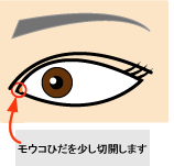 目頭切開(モウコひだ形成)
