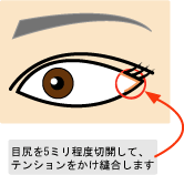 目尻切開にはこんなメリットが