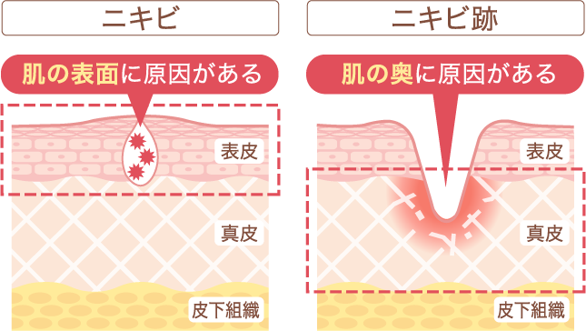 にきび跡とは