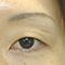 二重まぶた・タルミ取り