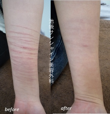 リストカットがやめられない理由とは?依存の仕組みと今日から試せる4つの対処法 4 リストカット治療写真