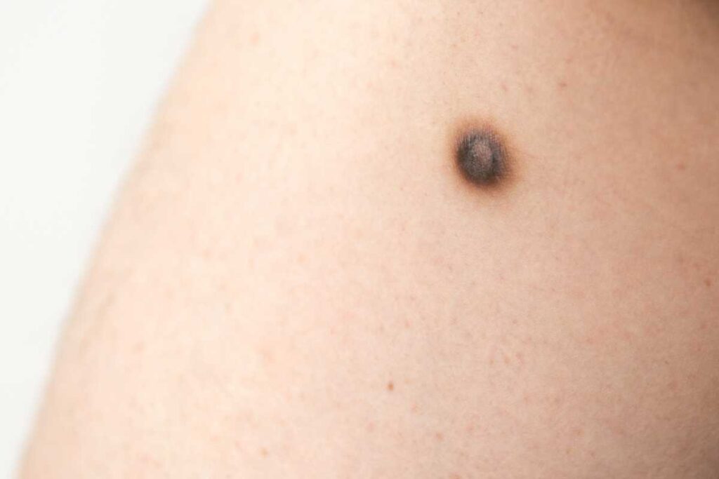 ほくろ除去は自分でできる?方法やクリーム・カソーダの効果を徹底比較 4 自分で除去してはいけないほくろのイメージ