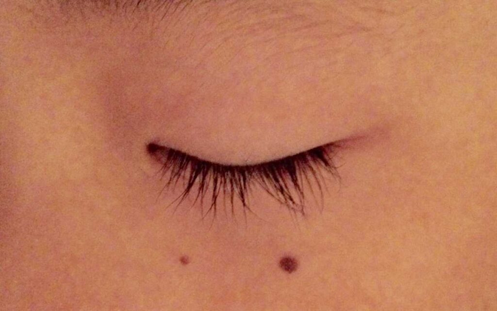 ほくろ除去は自分でできる?方法やクリーム・カソーダの効果を徹底比較 3 自分でほくろ除去を行うリスクを知らない人のイメージ