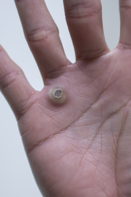 ウイルス性イボのフリー素材