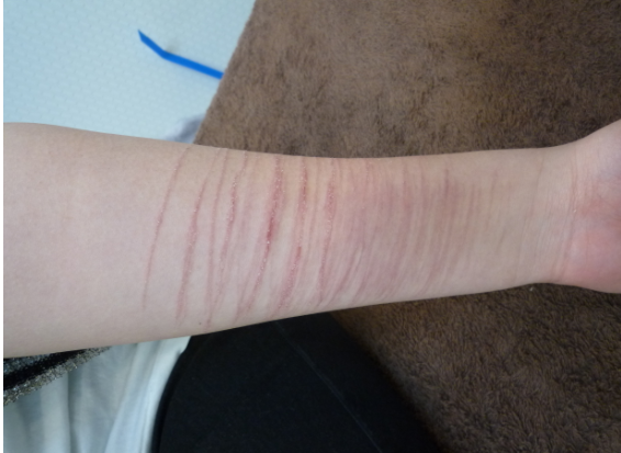 リストカットがやめられない理由とは?依存の仕組みと今日から試せる4つの対処法 2 リストカットをやめられない人の手首