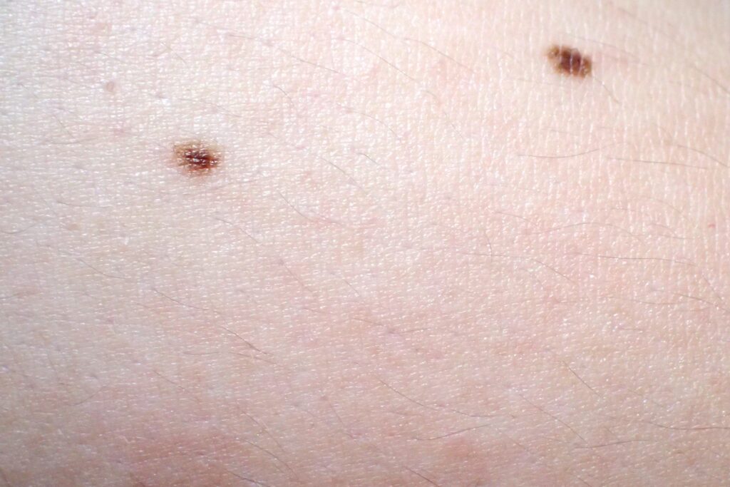 ほくろがおおきくなったイメージ