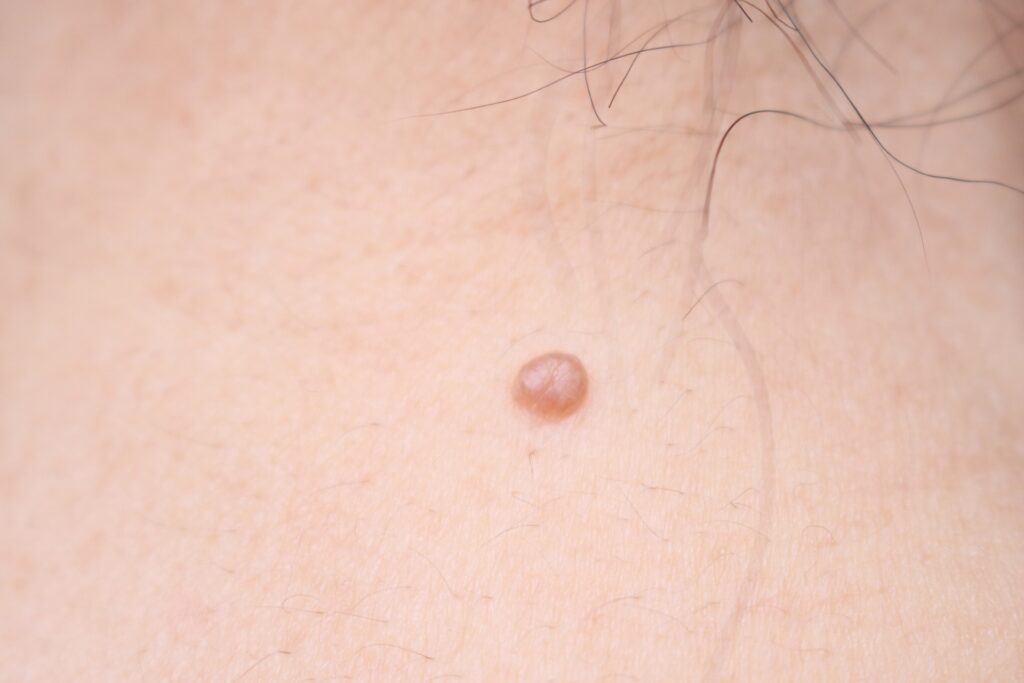 ほくろが大きくなった場合の対処法を紹介するイメージ