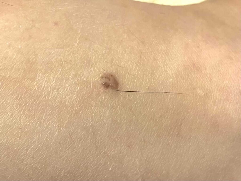 ほくろから毛が生えているイメージ