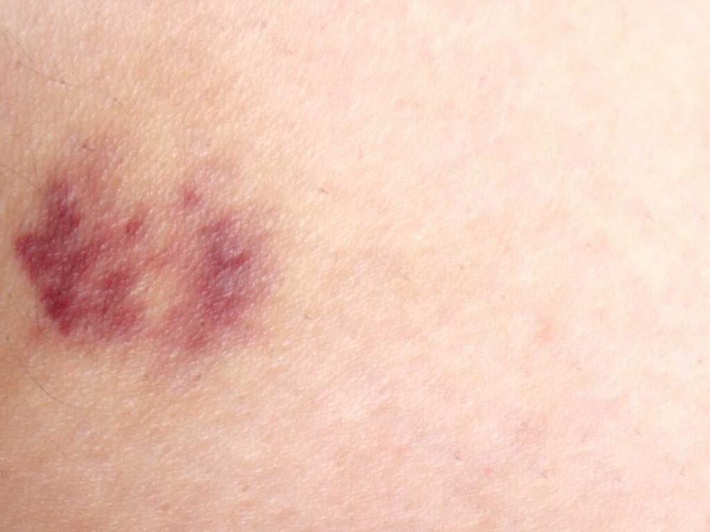 突然できたあざを放置していいか判断するためのチェックポイント