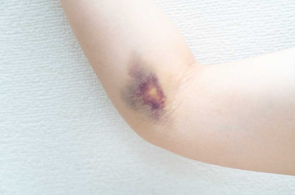 いつのまにができるあざの主な原因を解説