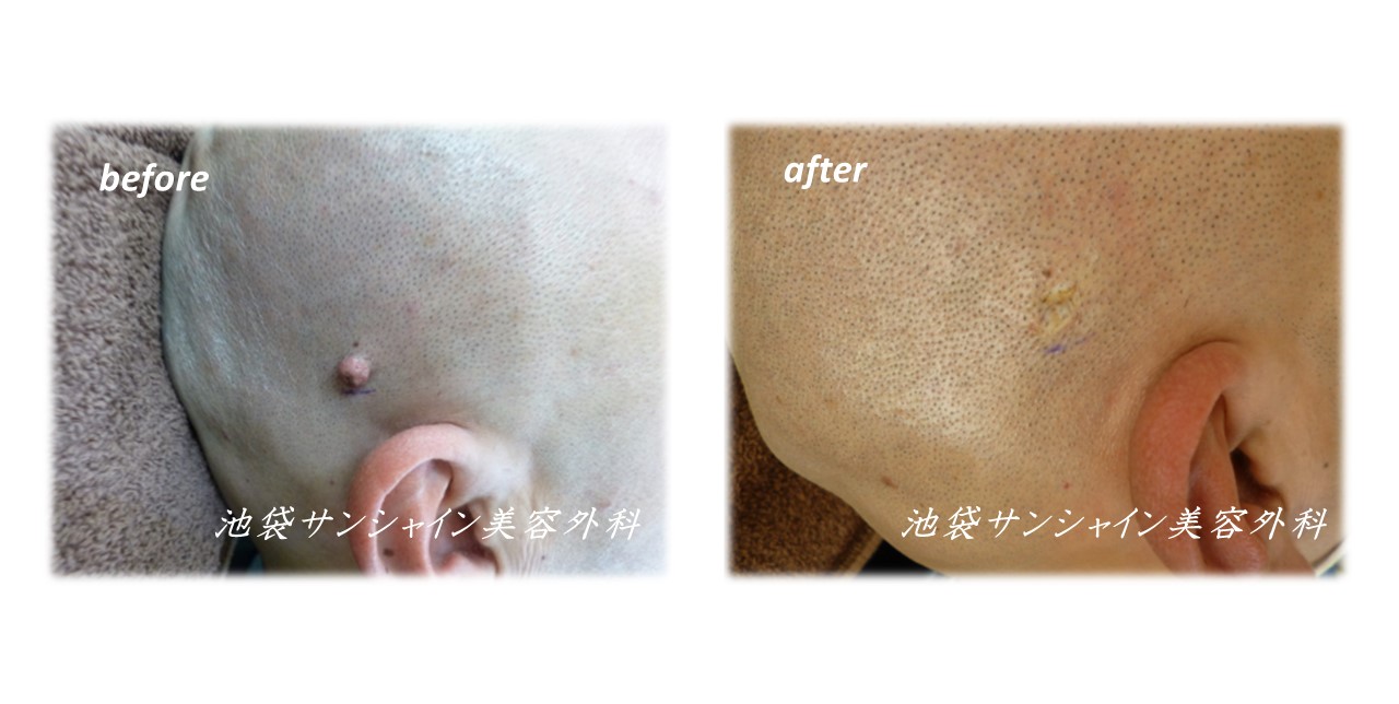 レーザーによるほくろ除去の症例写真