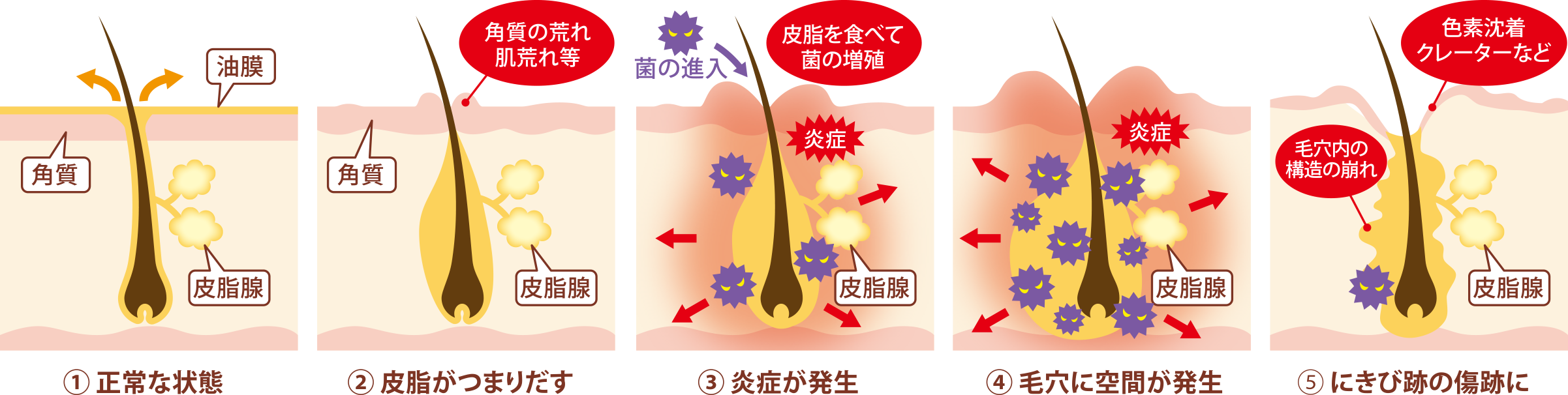 にきびが治らない原因