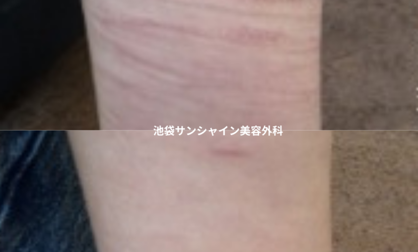 赤いリストカット傷跡１