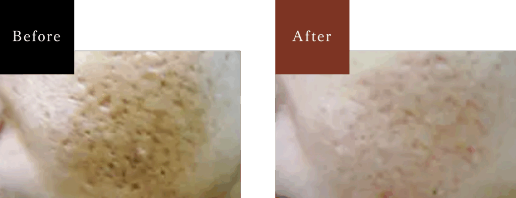 女性 両頬の治療