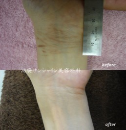 リストカットの症例情報