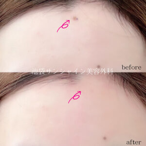 額のほくろ除去