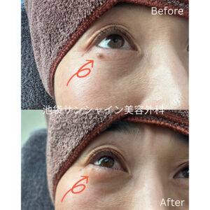 目元のほくろ除去