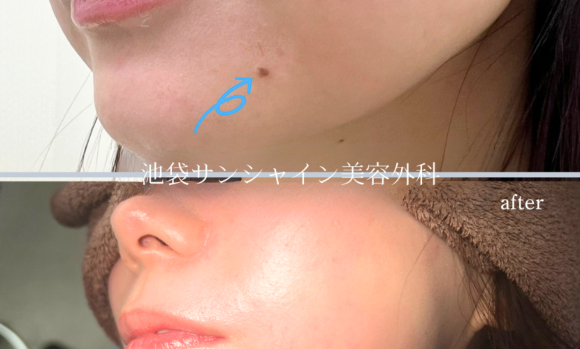 顎のほくろ除去 症例