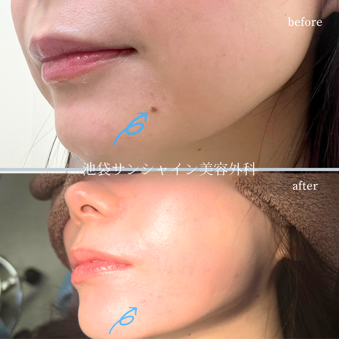 顎のほくろ除去 症例