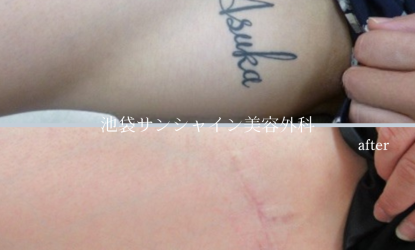 太ももタトゥー除去 before after