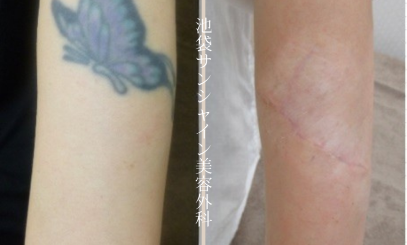 左上腕のタトゥー除去 before after
