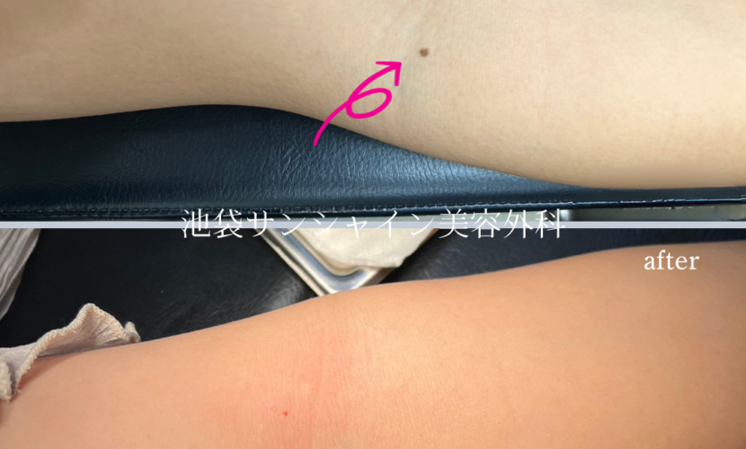 左上腕ほくろ除去 症例