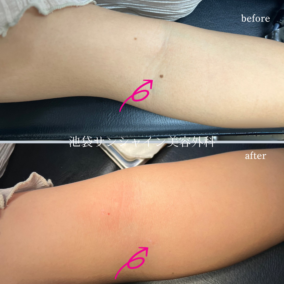 左上腕ほくろ除去 症例