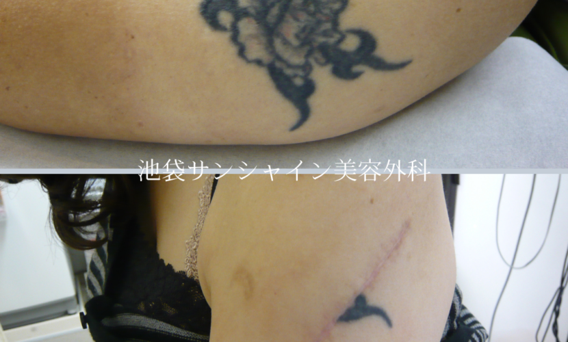 左腕タトゥ除去before after