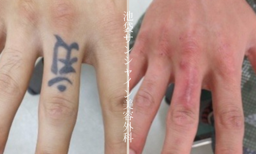 手の指タトゥー除去 before after