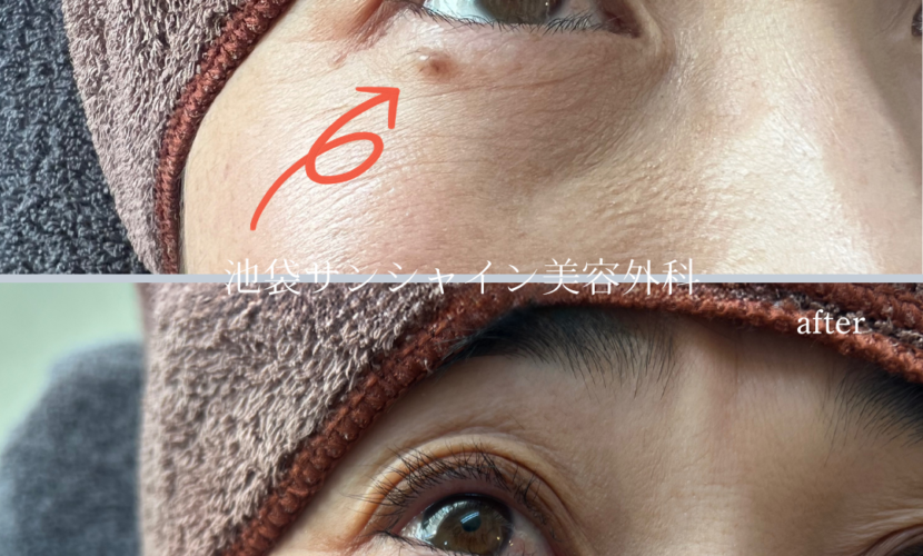 目元のほくろ除去 症例