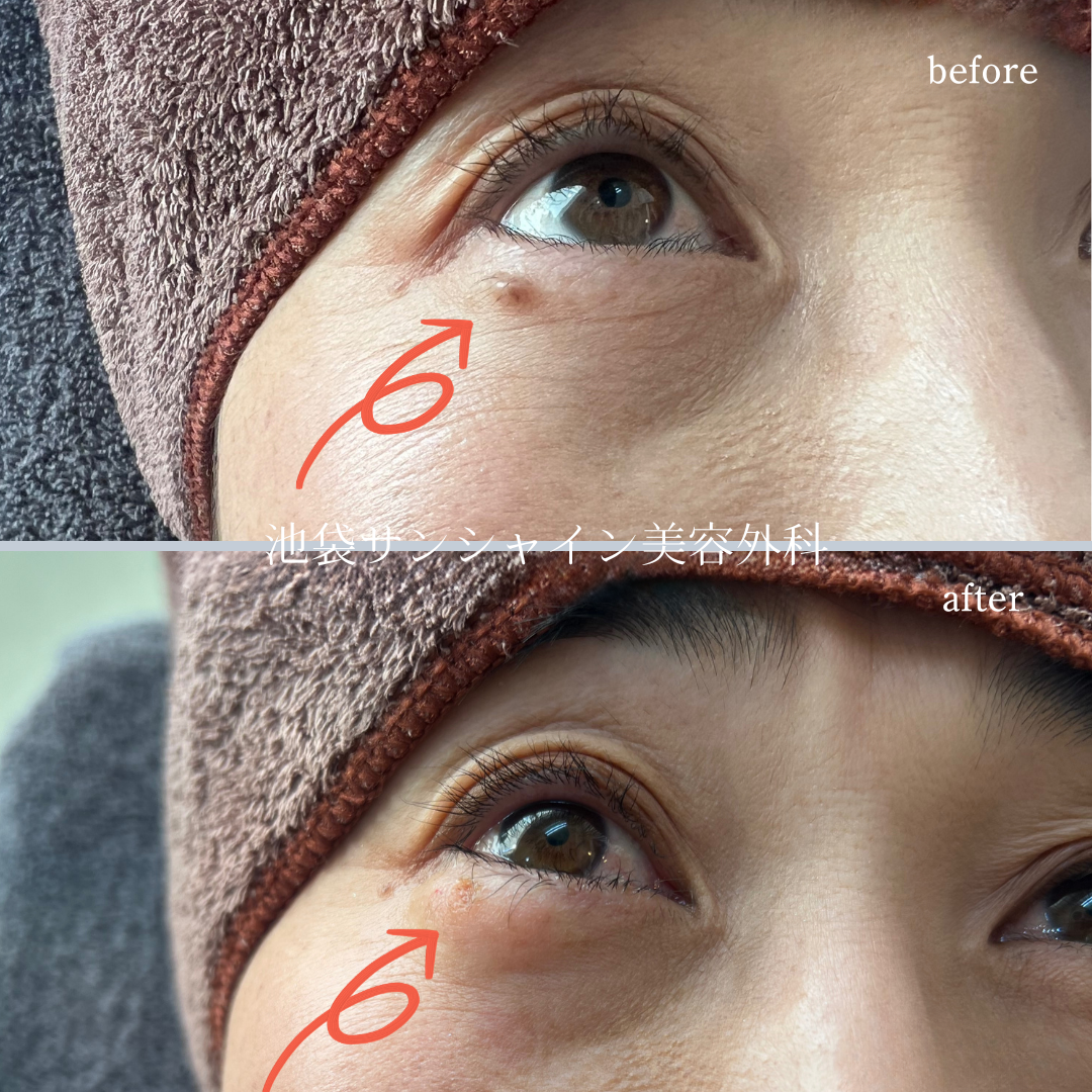 目元のほくろ除去 症例