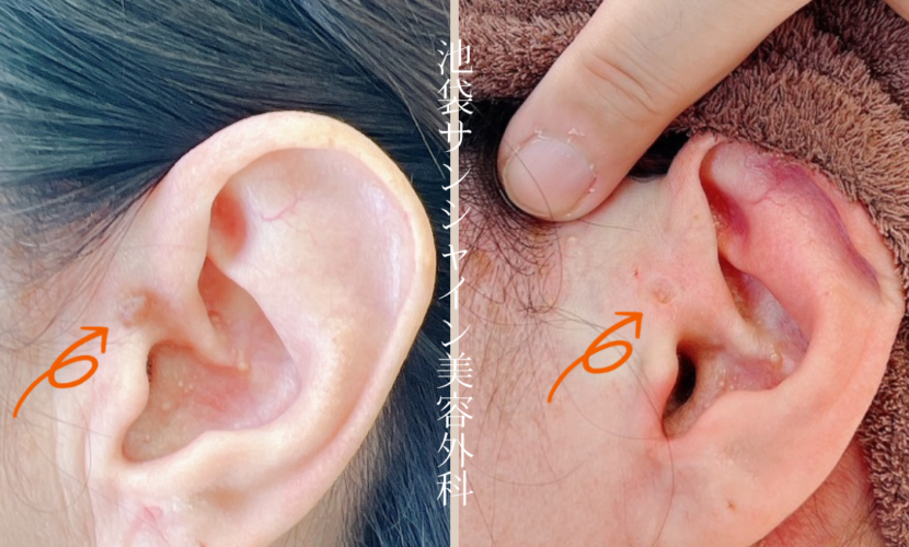 耳のほくろ除去 症例