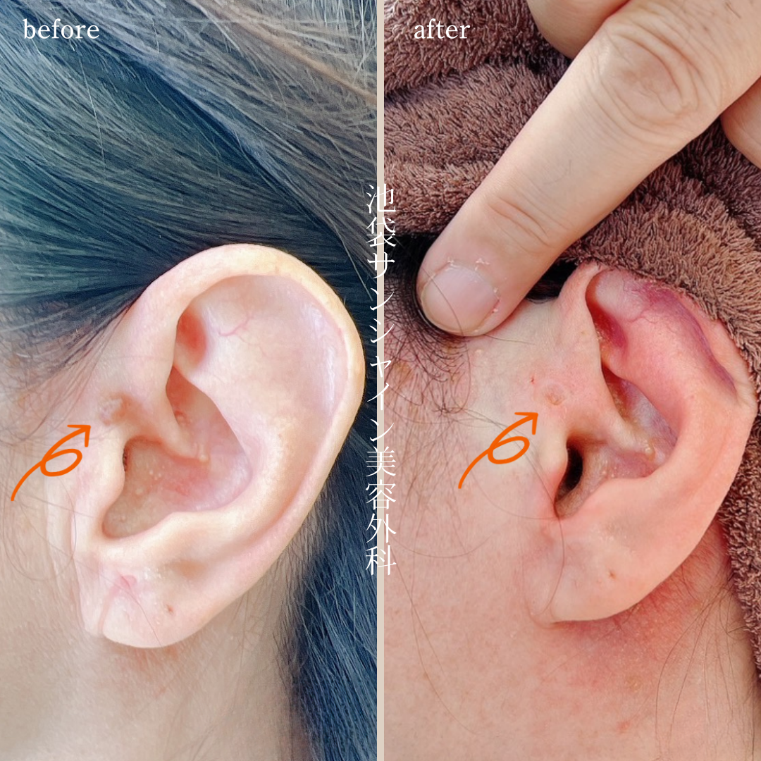 耳のほくろ除去 症例