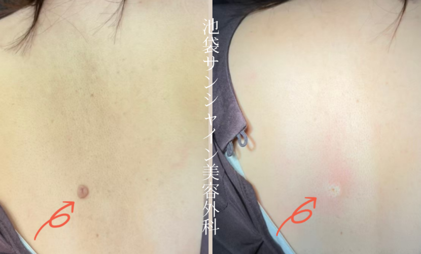 背中のほくろ除去症例