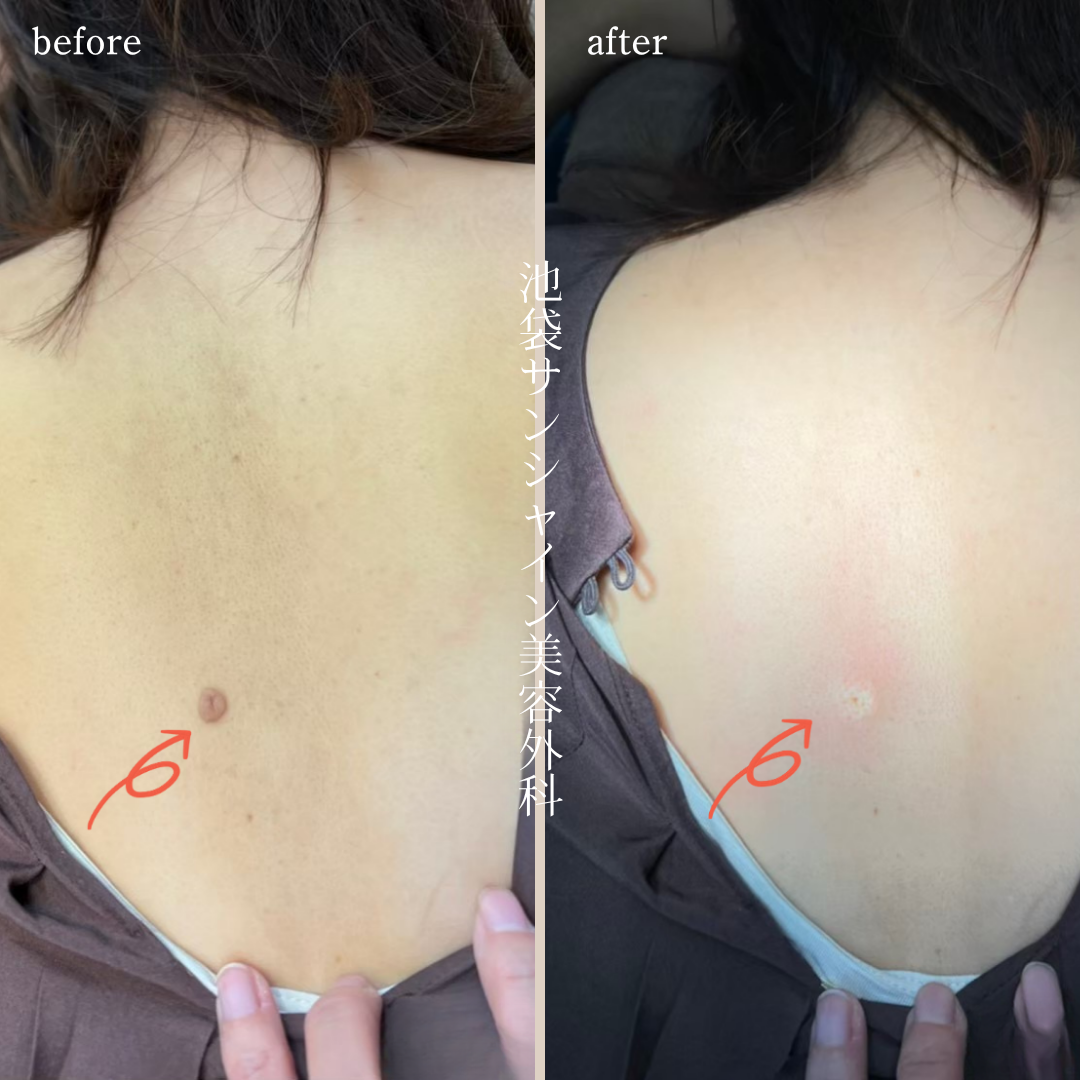 背中のほくろ除去症例