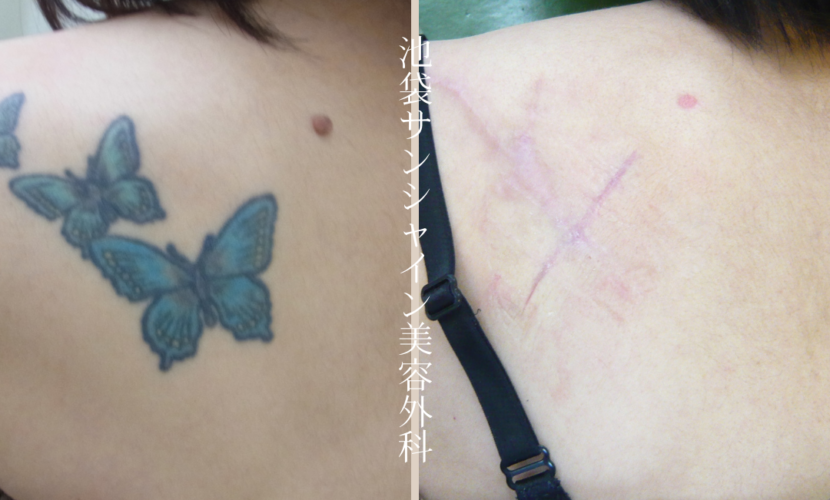 背中のタトゥー除去 before after