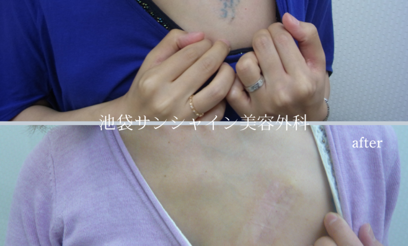 胸部タトゥ除去 before after