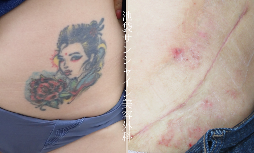 腹部・腰タトゥ除去 before after