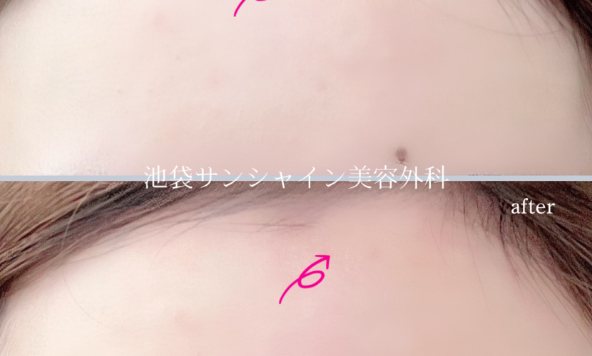 額のほくろ除去 症例