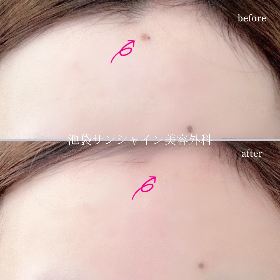 額のほくろ除去 症例