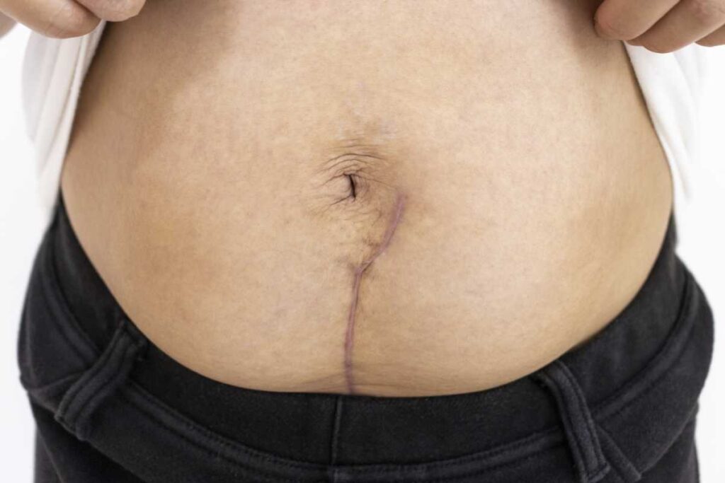 permanent-scar-treatment