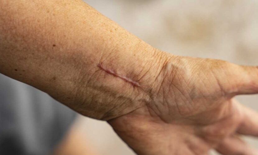 scar-removal-methods