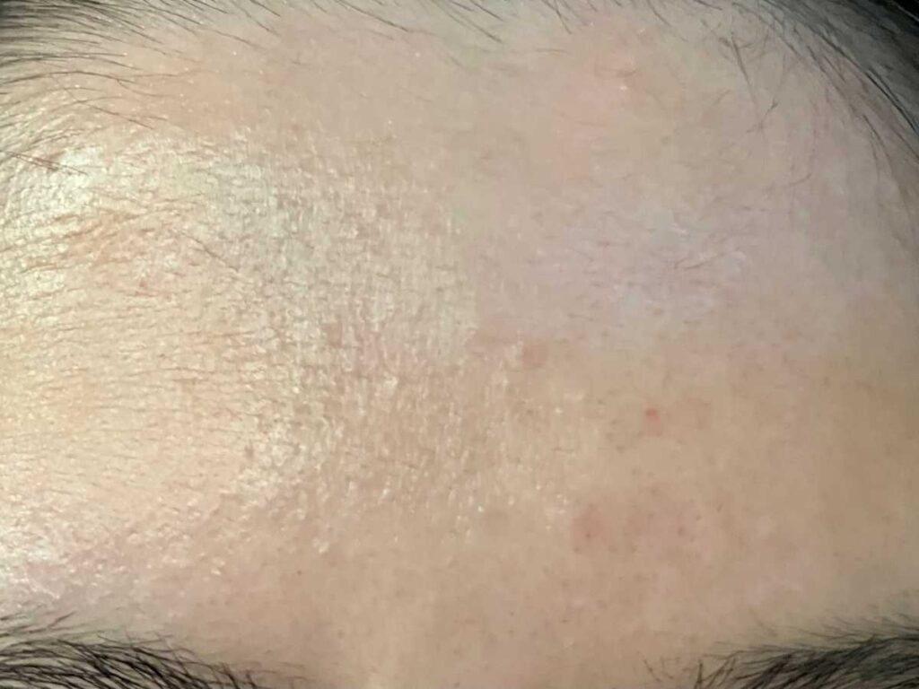 凹みのある傷を治す際によくある質問