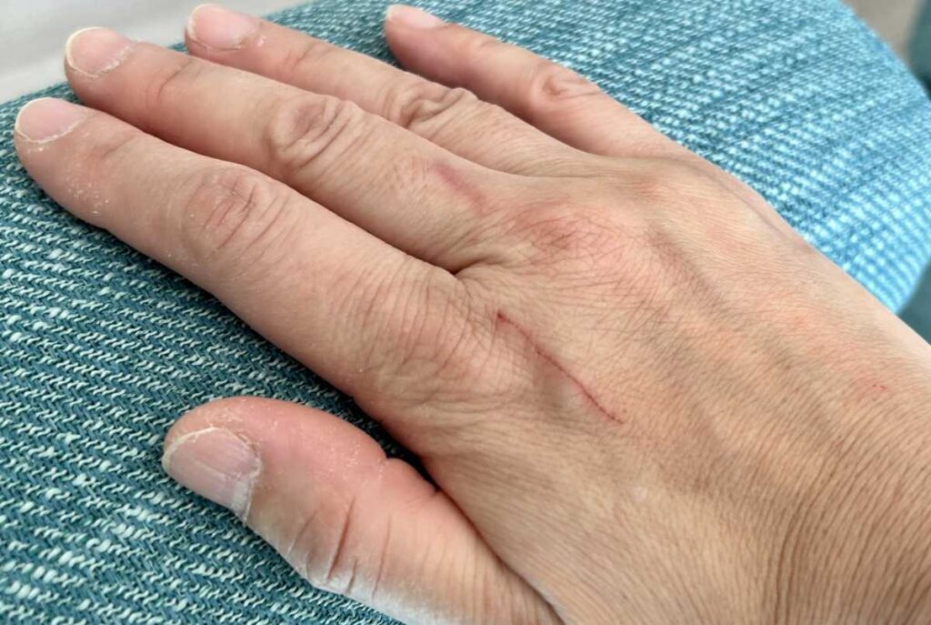 傷跡修正はアートメイクよりも医療の方がきれいになることを紹介しているイメージ