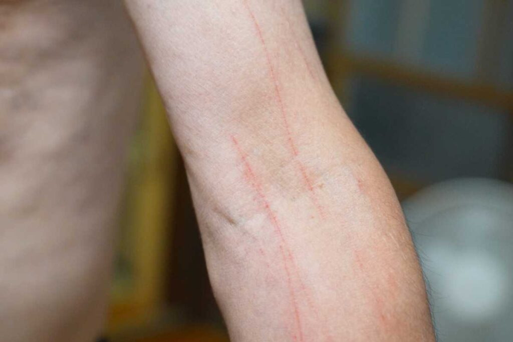 傷跡修正アートメイクのデメリットを紹介