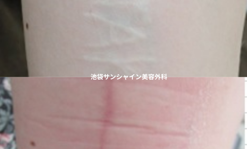 白い傷跡の治療１