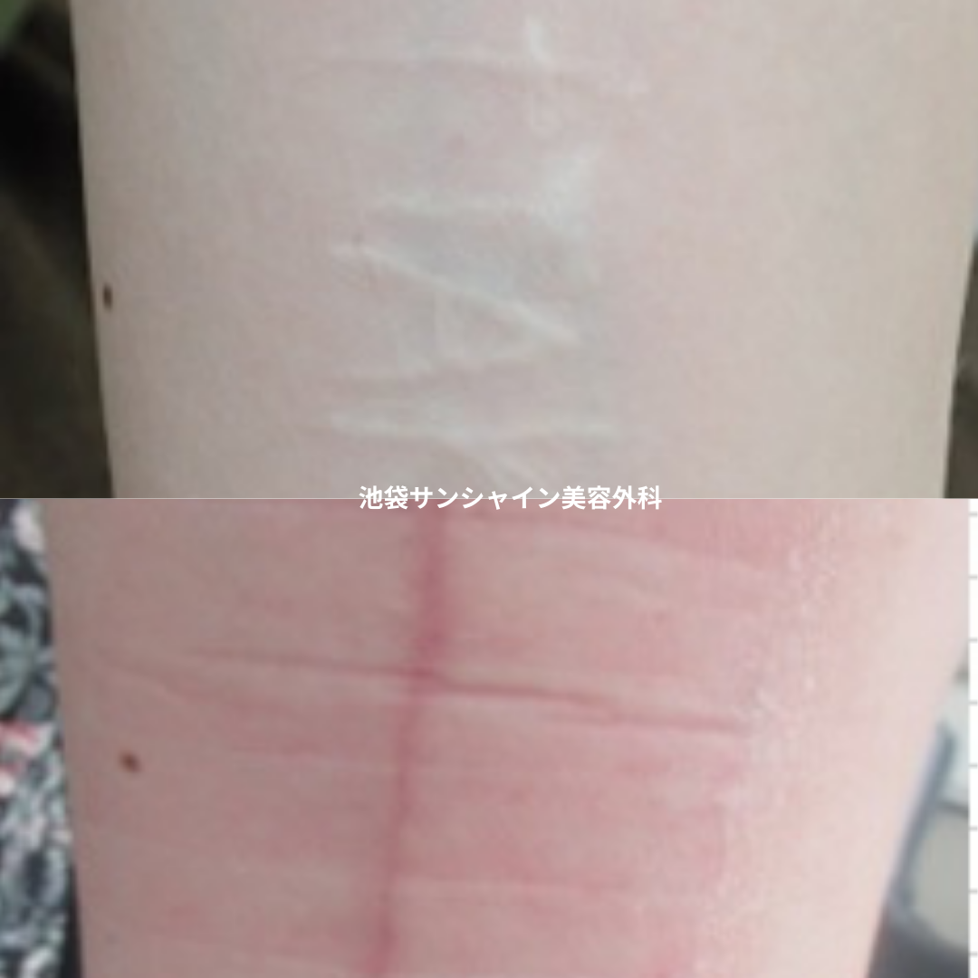 白い傷跡の治療１