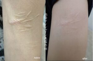 盛り上がった傷の治療症例